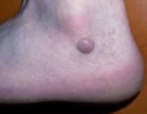 Dermatofibroma on the ankle